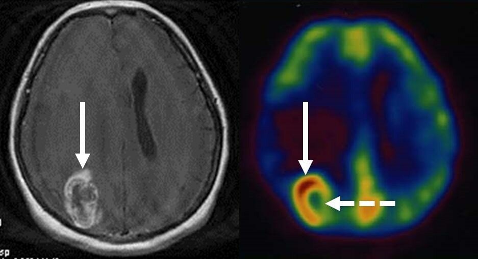 Гамма нож метастаз. Гамма нож метастаз. Гамма нож метастаз. Гамма нож принцип. Изменения головного мозга после гамма ножа.