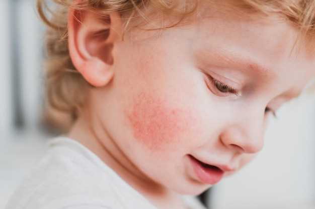 Атопический дерматит у детей: от чего возникает и как проявляется