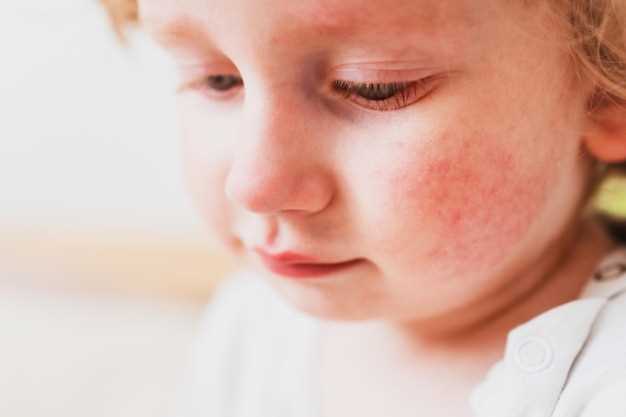 Симптомы поражения кожным клещом на лице