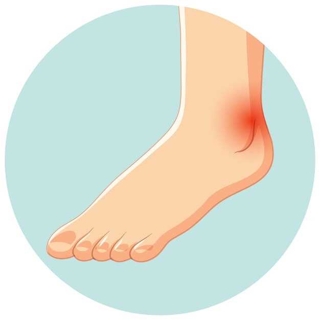 Почему возникают боли в стопе левой ноги сбоку с наружной стороны